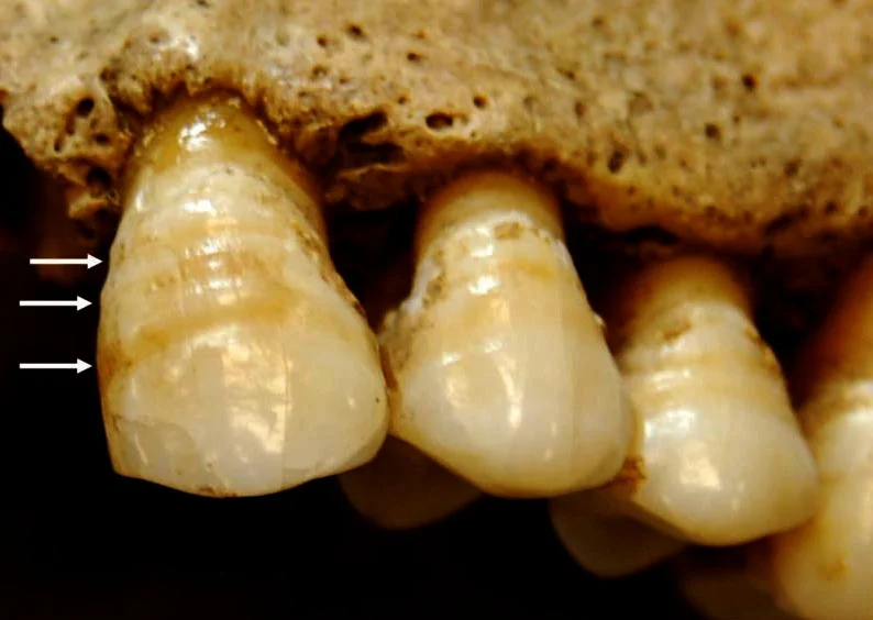 Skeletal marker: Linear enamel hypoplasia. (Credit: Sharon DeWitte)