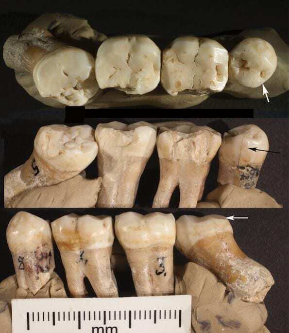 analysis of neanderthal teeth grooves uncovers evidence of prehistoric dentistry