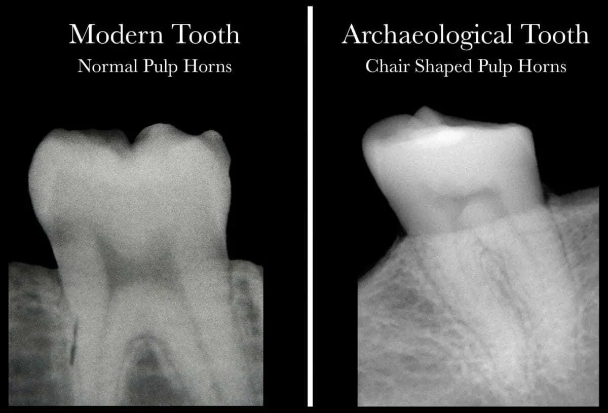 science meets archaeology with discovery that dental x-rays reveal vitamin d deficiency